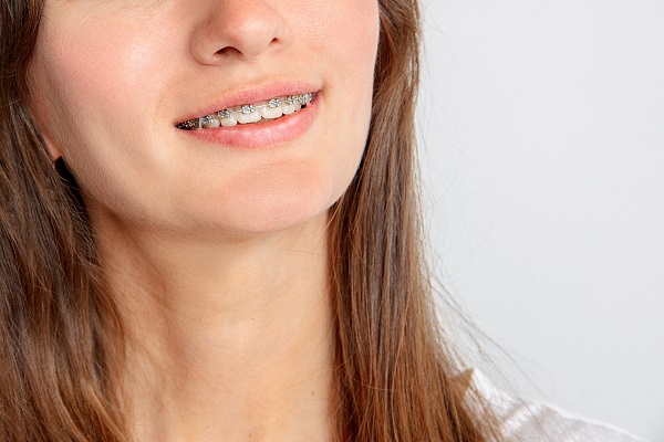 Adult Braces: What Are Your Options?