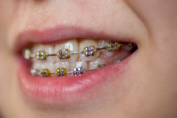 FAQs About Ceramic Braces For Kids