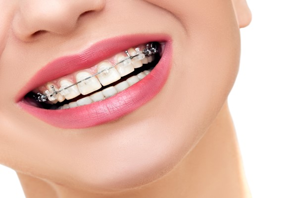 Traditional Braces Vs  Clear Braces For Teens