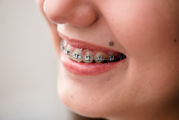 What Is The Difference Between An Orthodontist And A Pediatric Orthodontist?